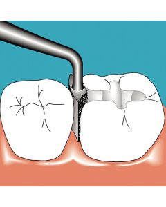 Sonicflex Approx nr. 36 stor, mesial